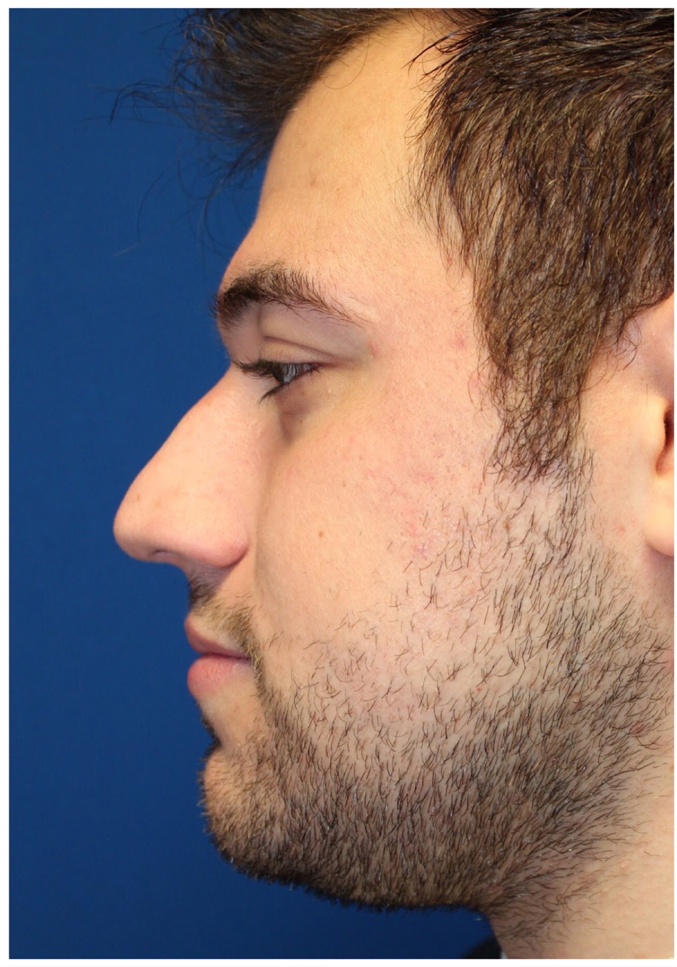 Male Cosmetic Rhinoplasty