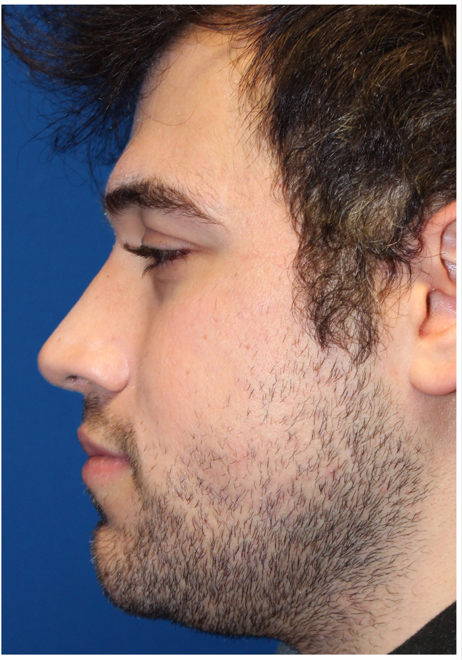 Male Cosmetic Rhinoplasty