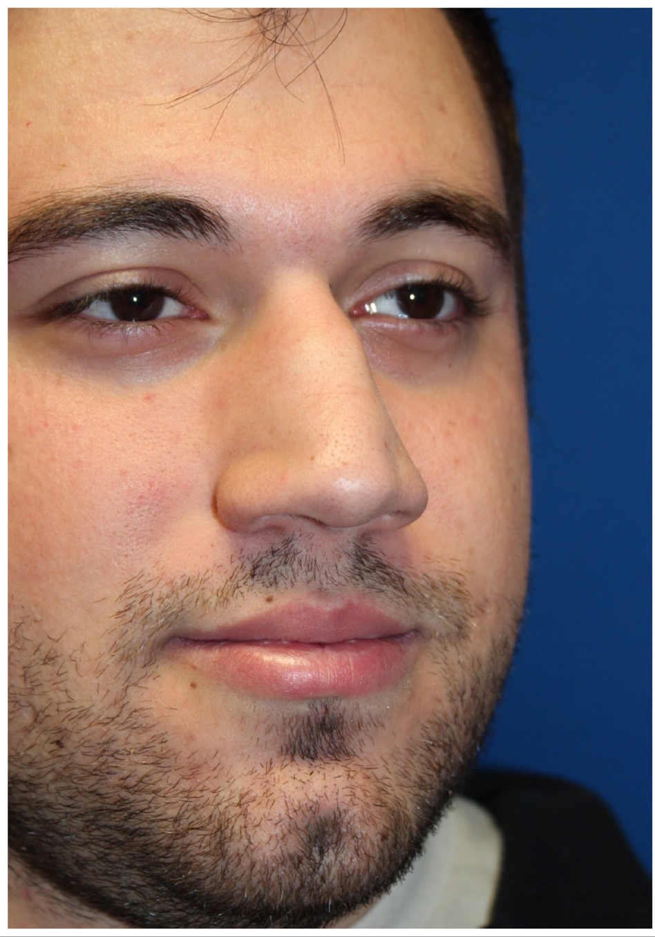 Male Cosmetic Rhinoplasty