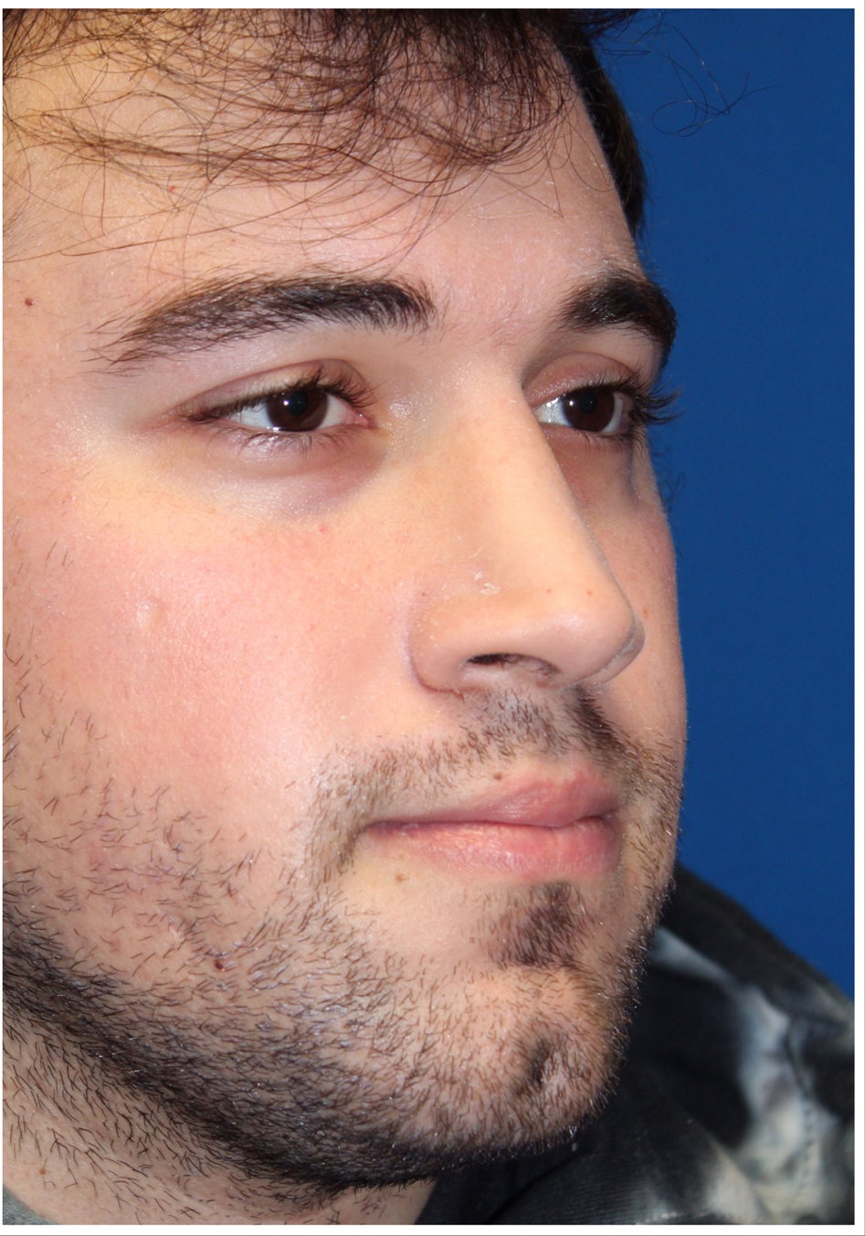 Male Cosmetic Rhinoplasty