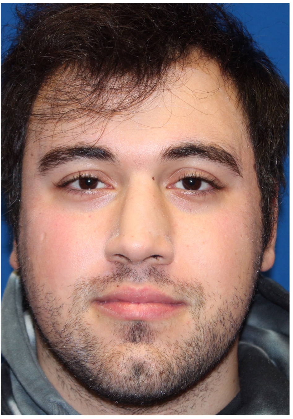 Male Cosmetic Rhinoplasty