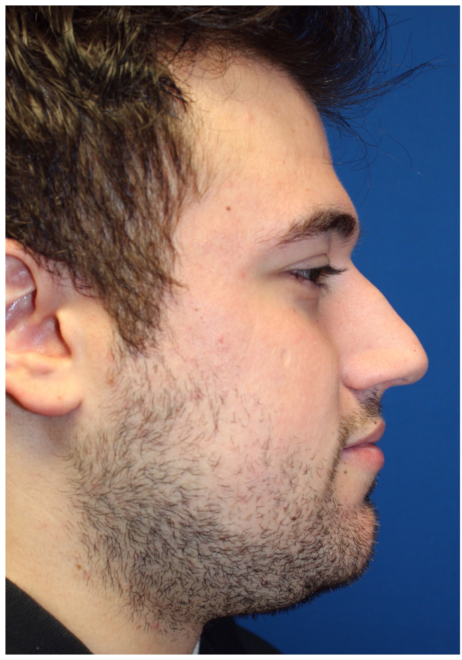 Male Cosmetic Rhinoplasty