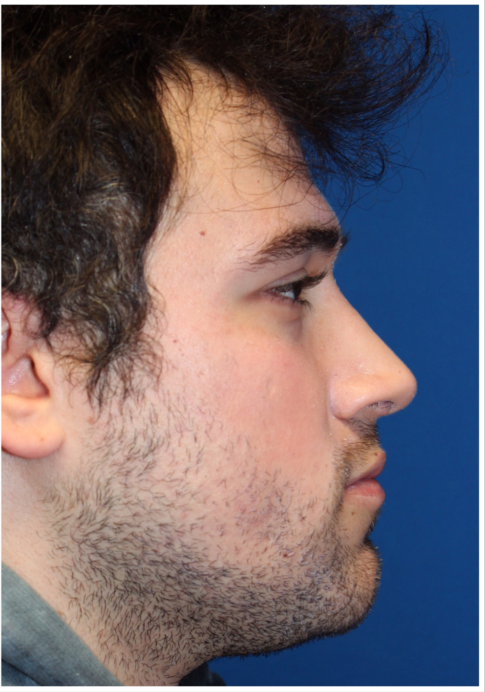 Male Cosmetic Rhinoplasty