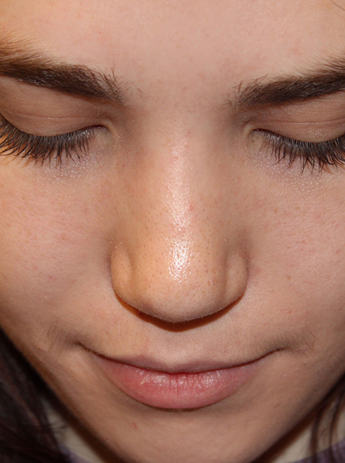 Female Cosmetic Rhinoplasty