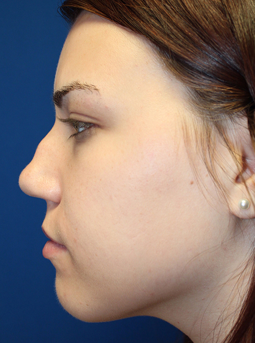 Female Cosmetic Rhinoplasty