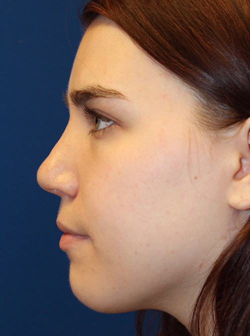 Female Cosmetic Rhinoplasty