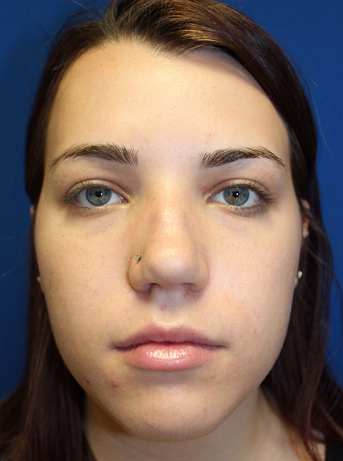 Female Cosmetic Rhinoplasty