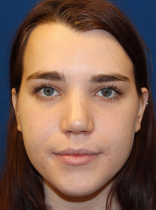 Female Cosmetic Rhinoplasty