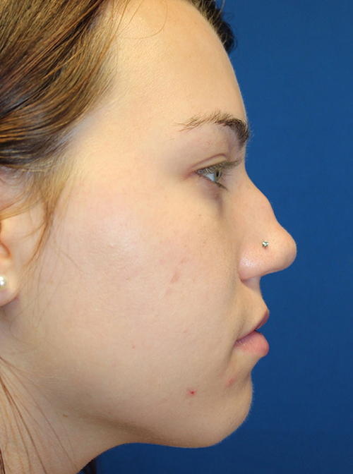 Female Cosmetic Rhinoplasty