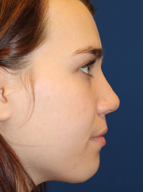 Female Cosmetic Rhinoplasty