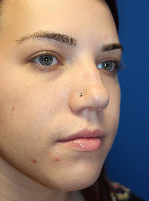 Female Cosmetic Rhinoplasty