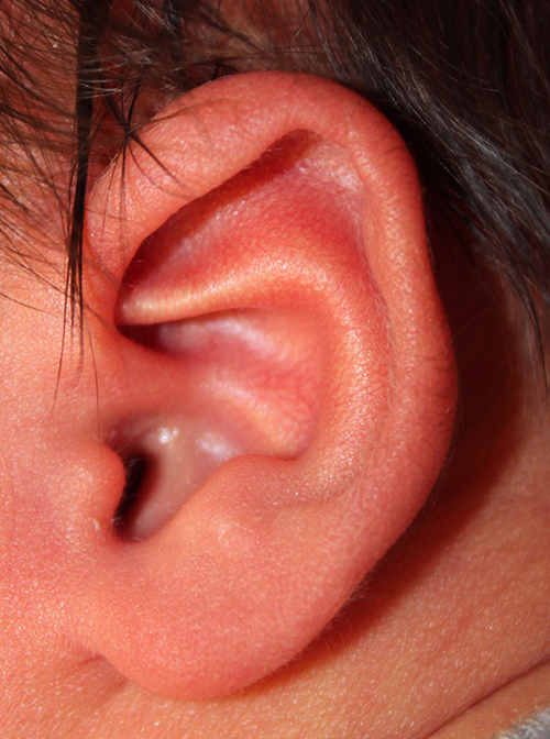 Ear Reshaping