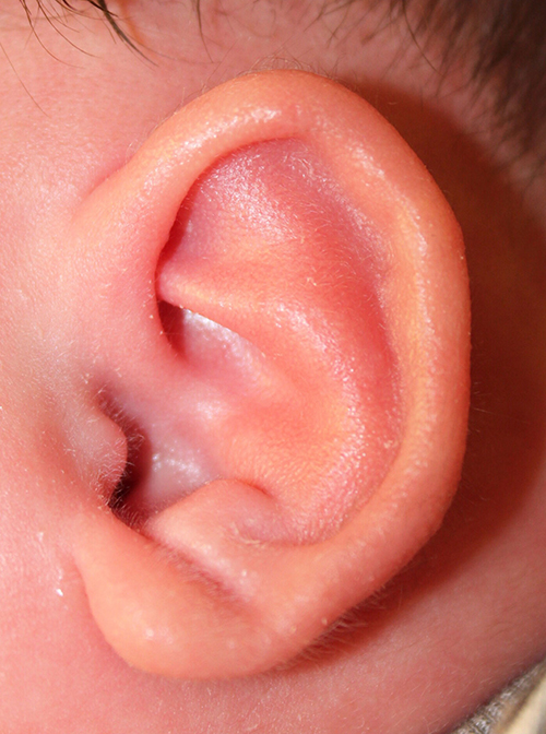 Ear Reshaping