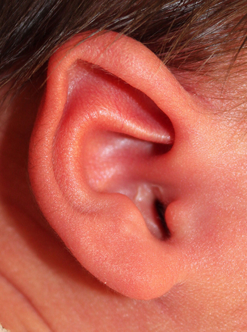 Ear Reshaping