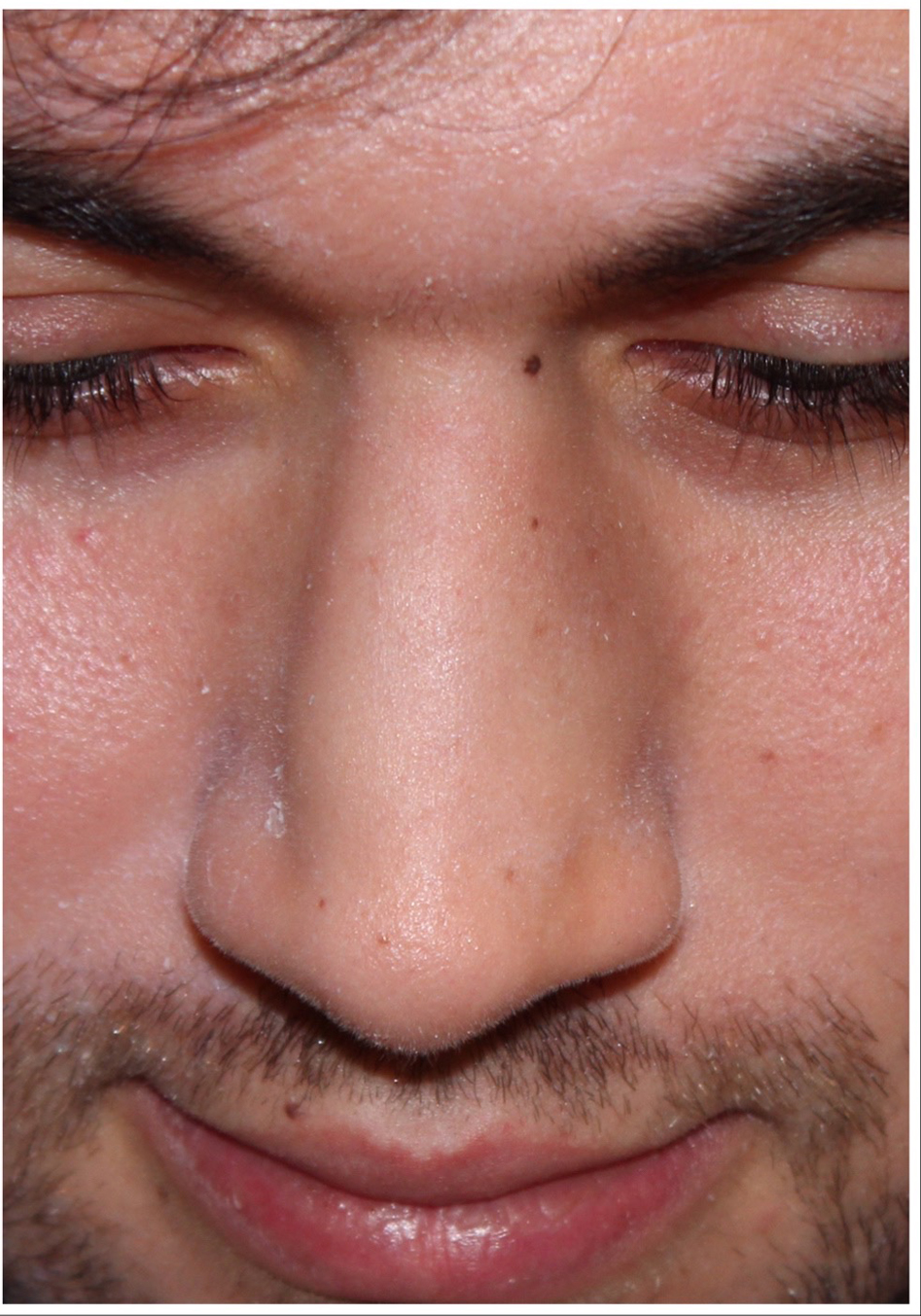 Male Cosmetic Rhinoplasty