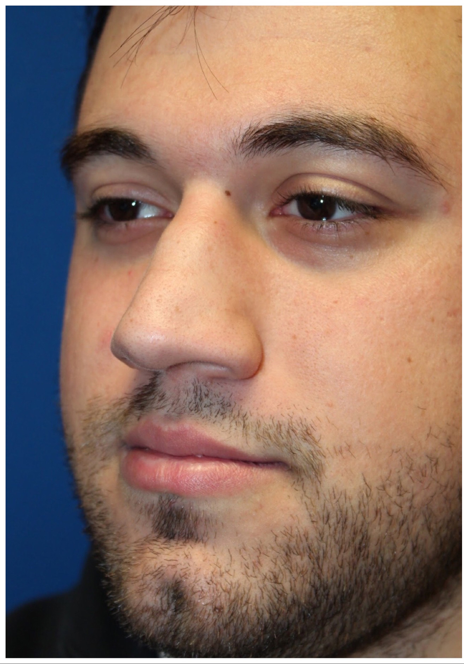 Male Cosmetic Rhinoplasty