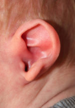 Ear Reshaping