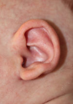 Ear Reshaping