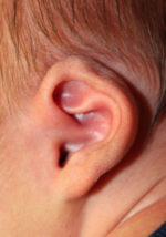 Ear Reshaping