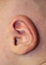 Ear Reshaping