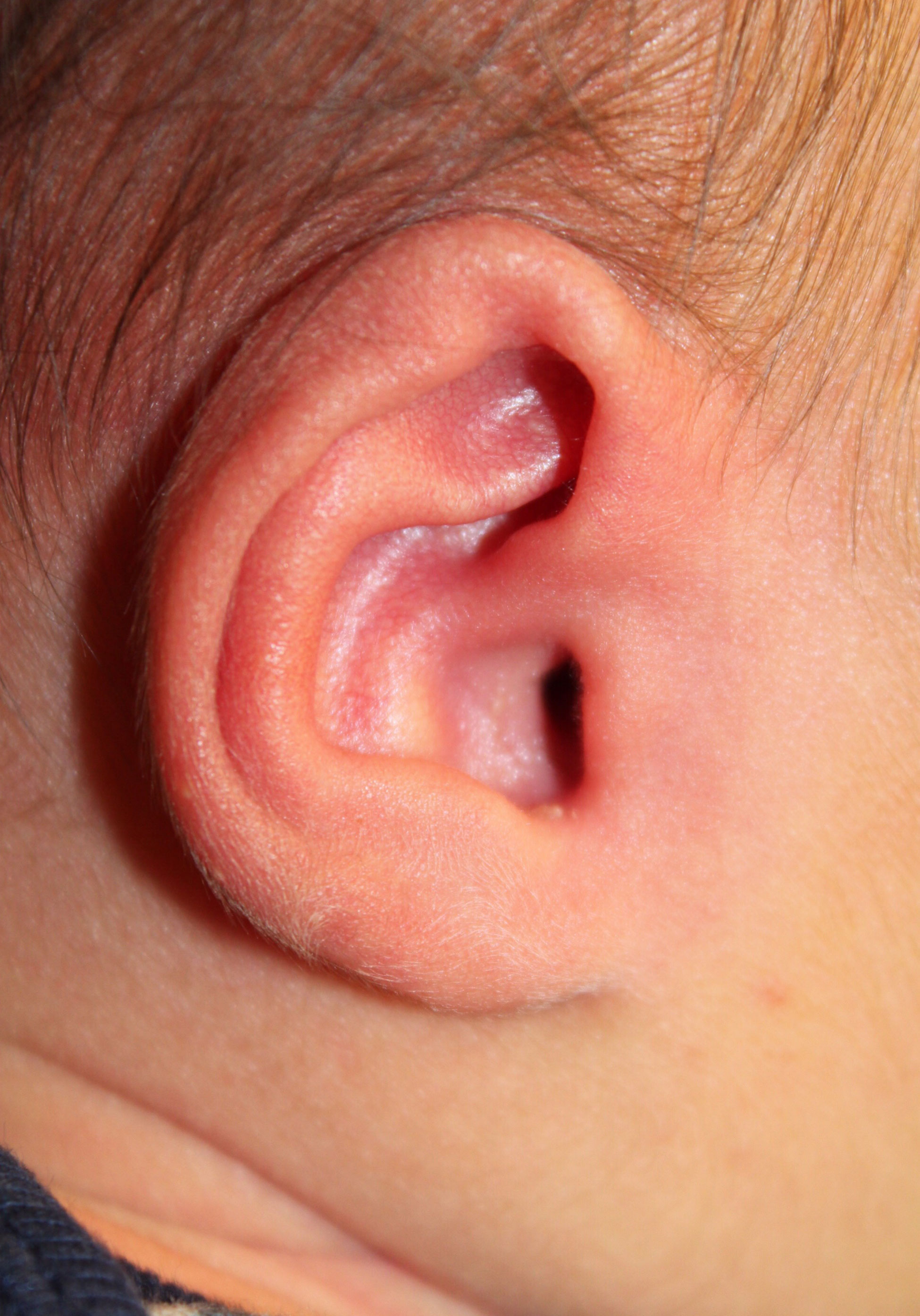 Ear Reshaping