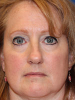 Female Cosmetic Rhinoplasty