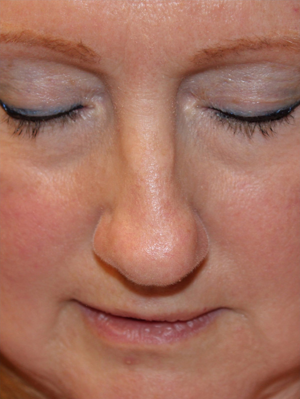 Female Cosmetic Rhinoplasty