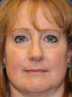 Female Cosmetic Rhinoplasty