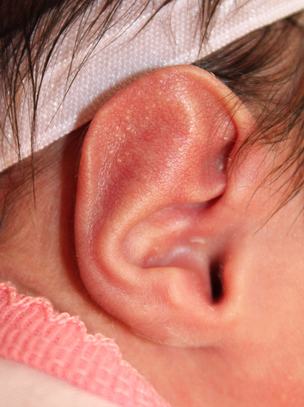 Ear Reshaping