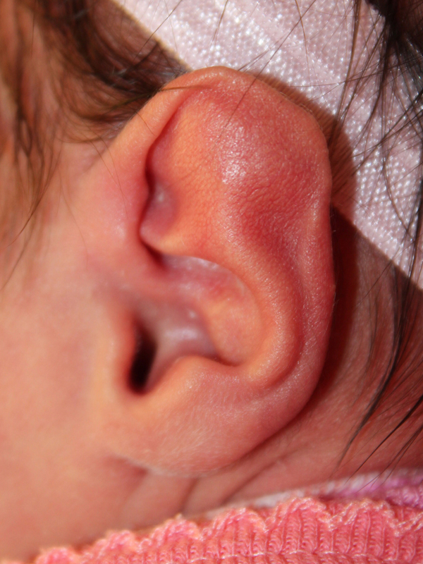 Ear Reshaping