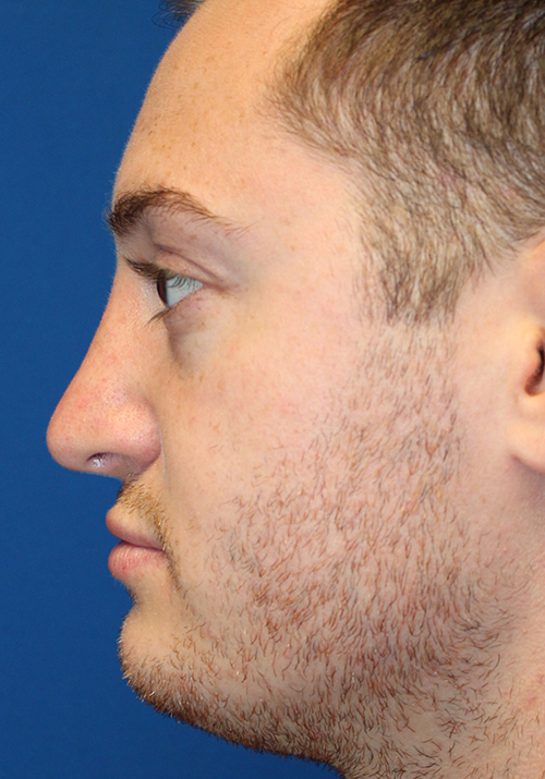 Male Cosmetic Rhinoplasty