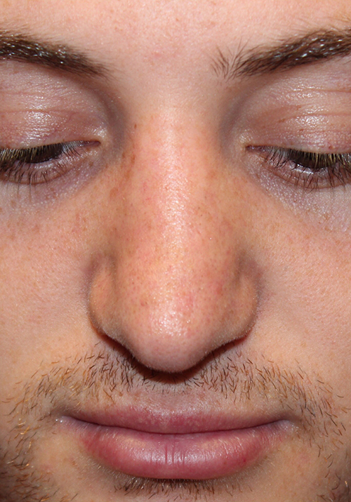 Male Cosmetic Rhinoplasty