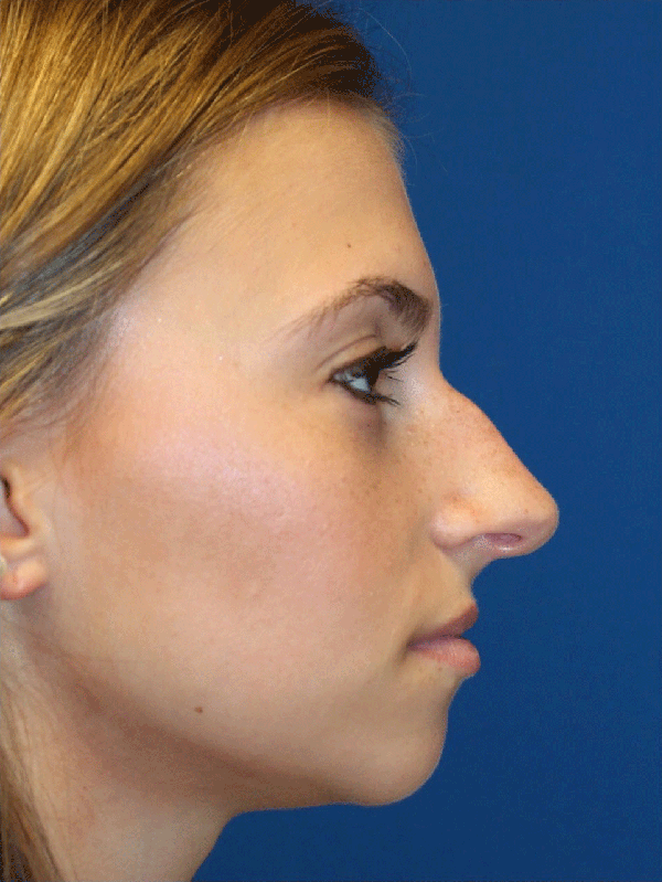 Female Cosmetic Rhinoplasty