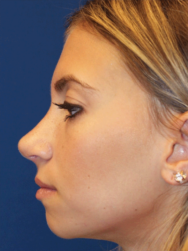 Female Cosmetic Rhinoplasty