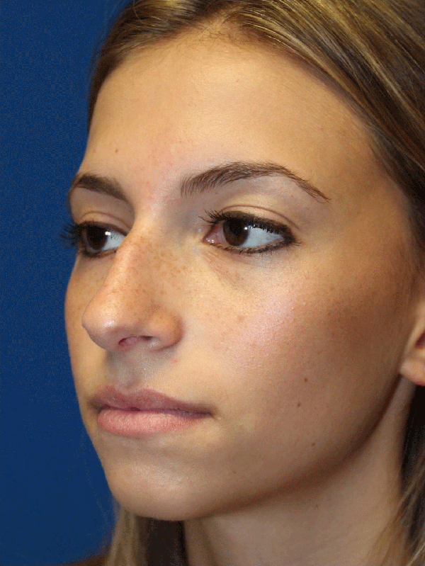 Female Cosmetic Rhinoplasty