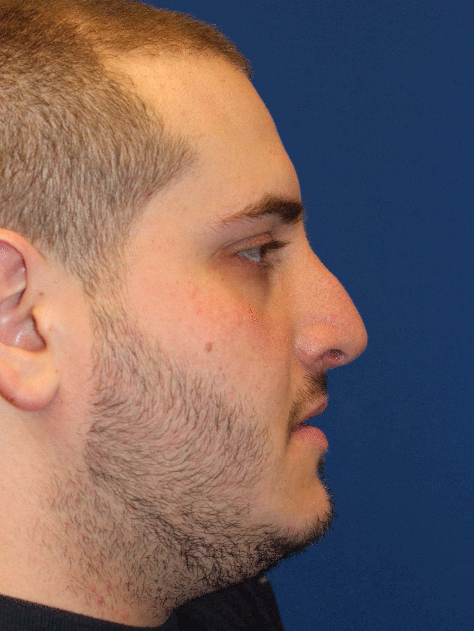 Male Cosmetic Rhinoplasty