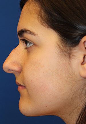 Female Cosmetic Rhinoplasty