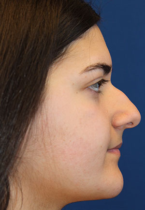 Female Cosmetic Rhinoplasty