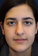 Female Cosmetic Rhinoplasty