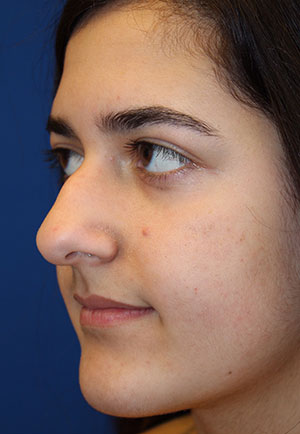 Female Cosmetic Rhinoplasty