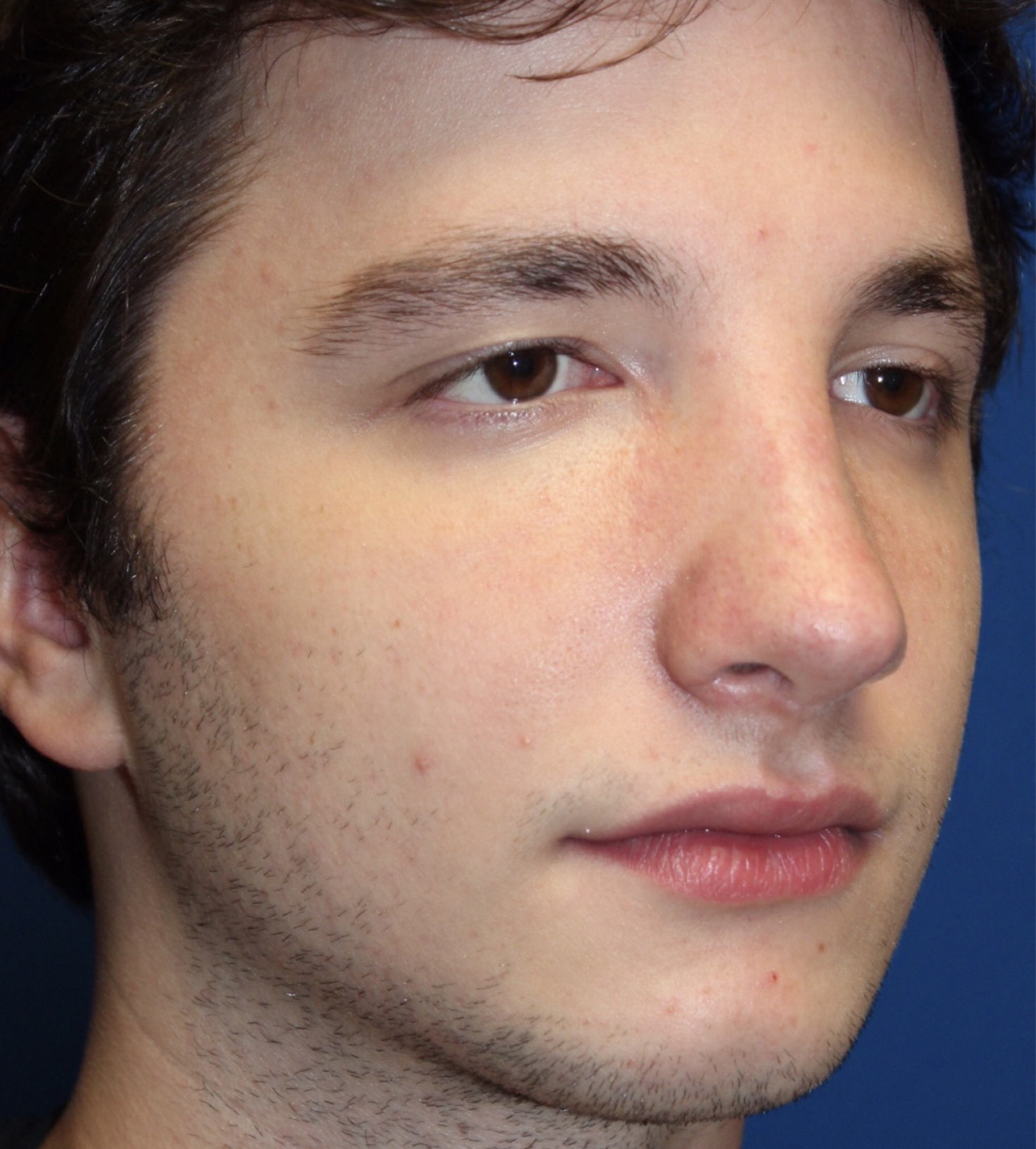 Male Cosmetic Rhinoplasty