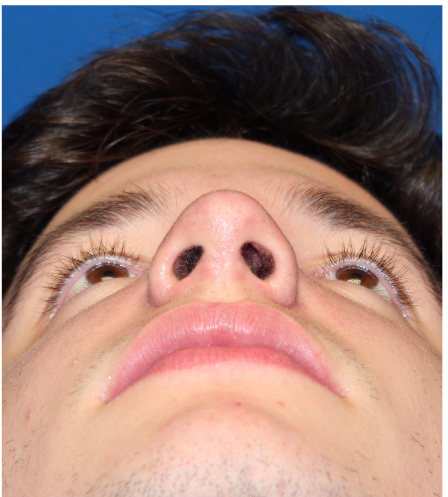 Male Cosmetic Rhinoplasty