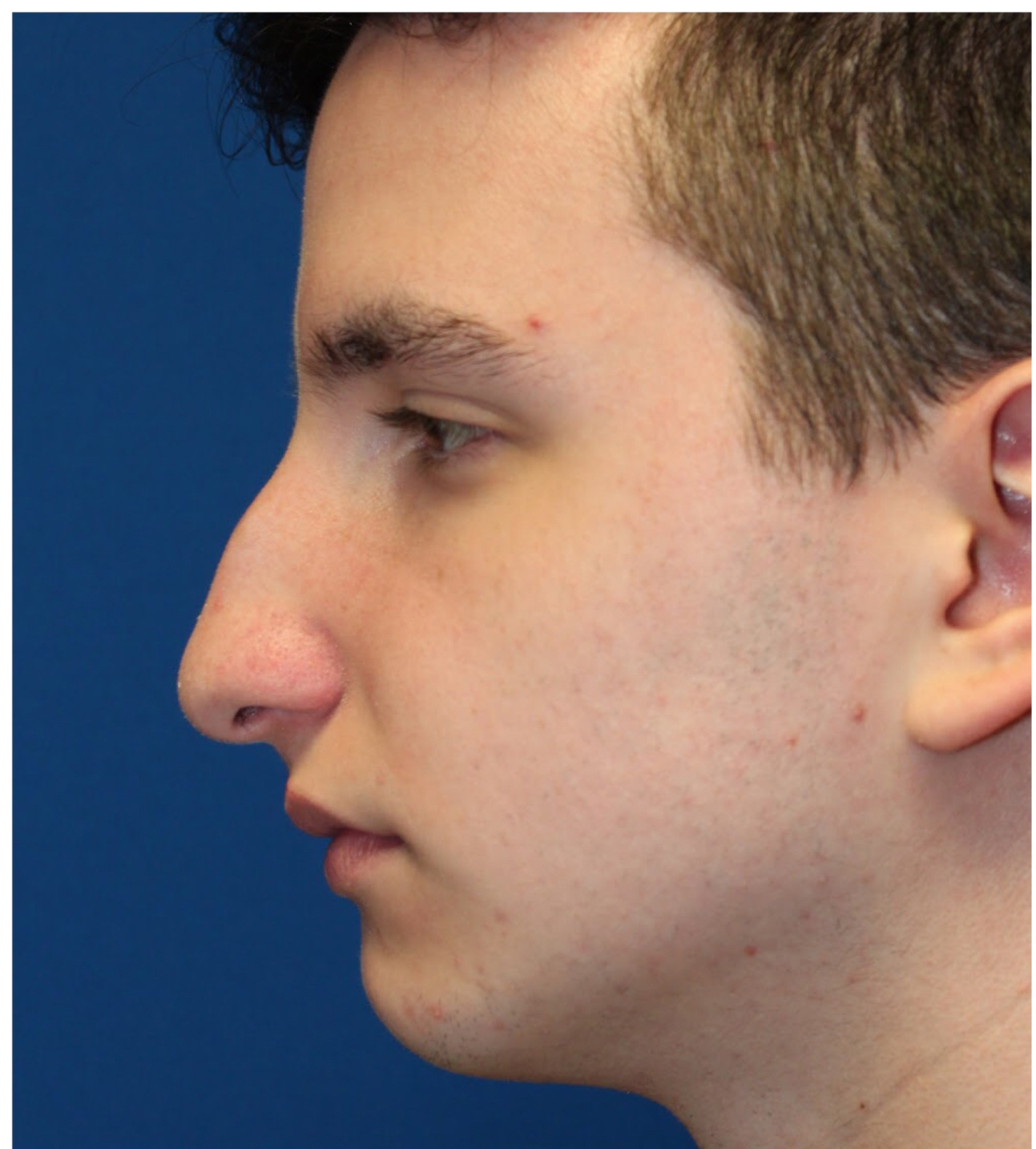 Male Cosmetic Rhinoplasty