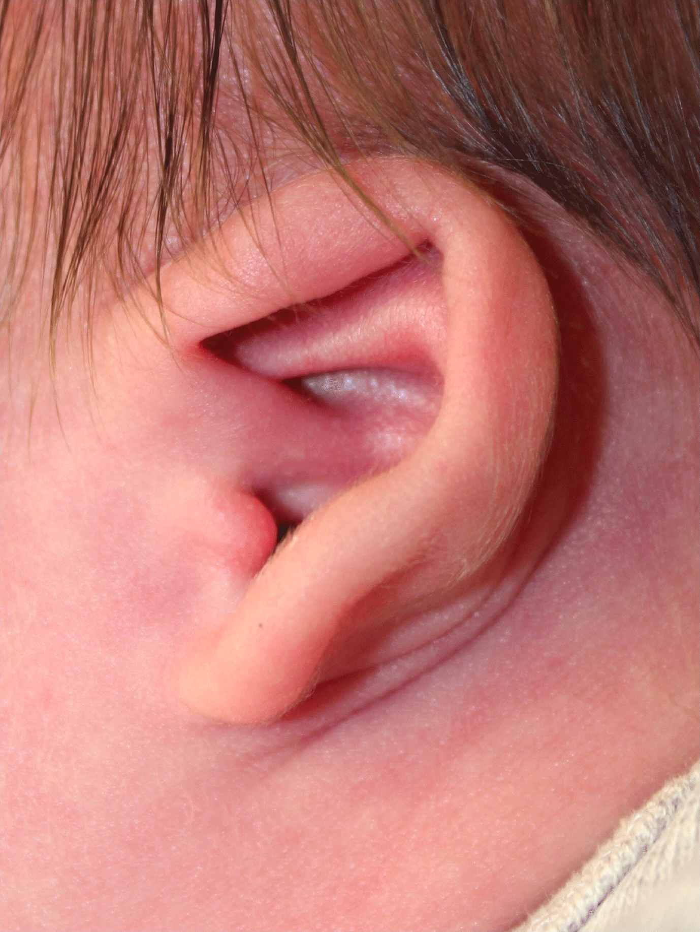 Ear Reshaping