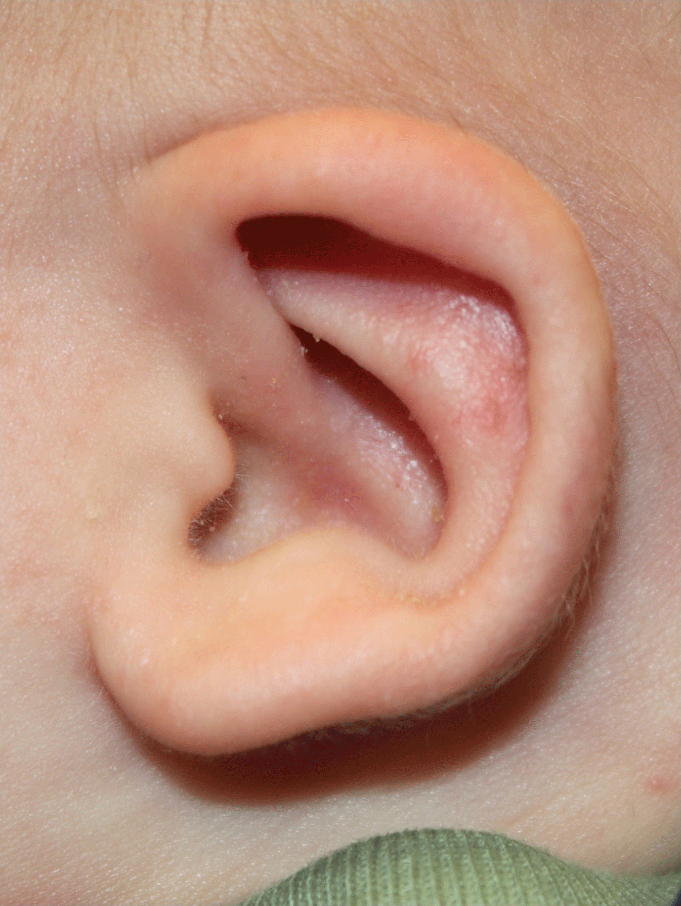 Ear Reshaping