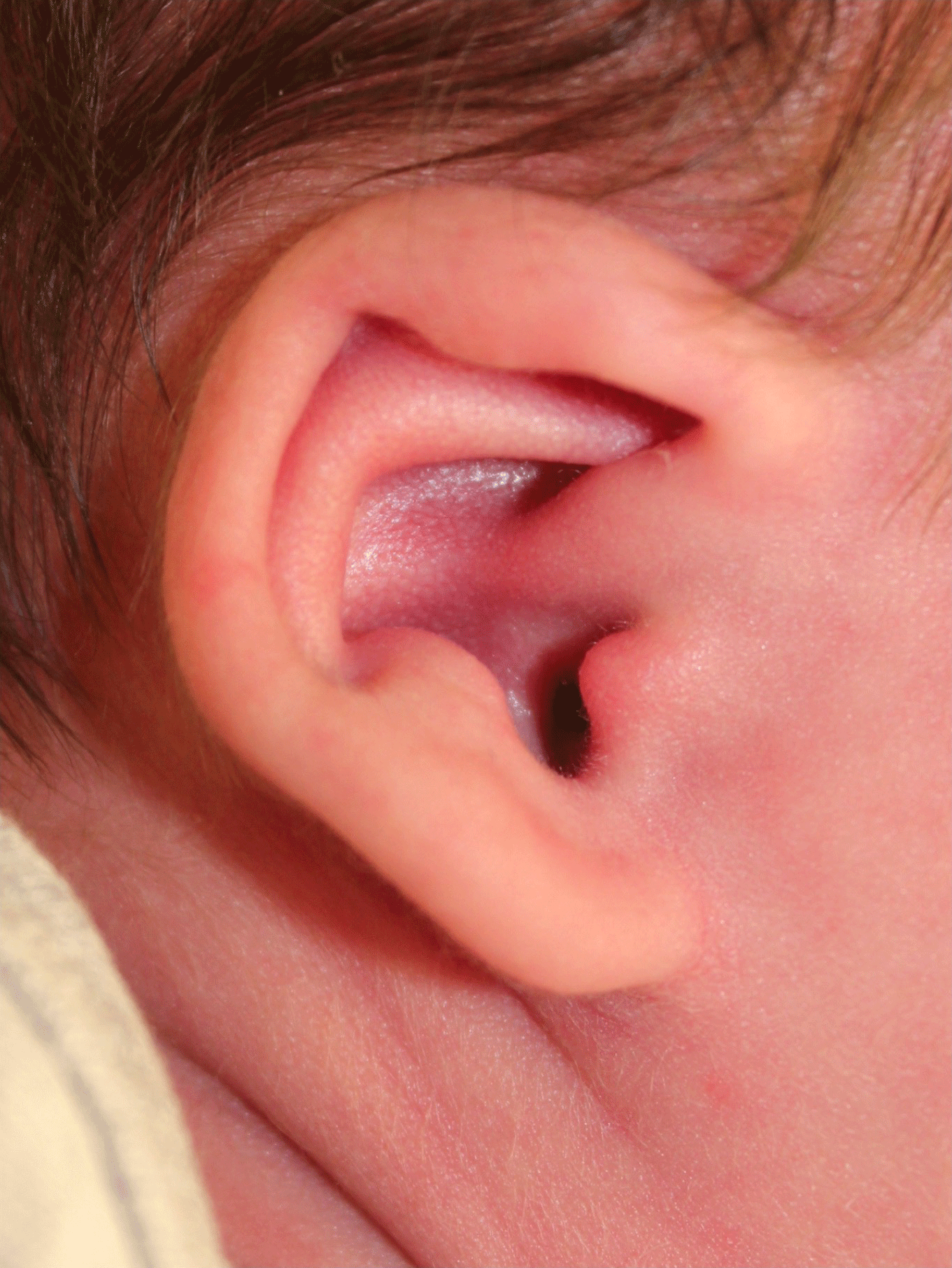 Ear Reshaping