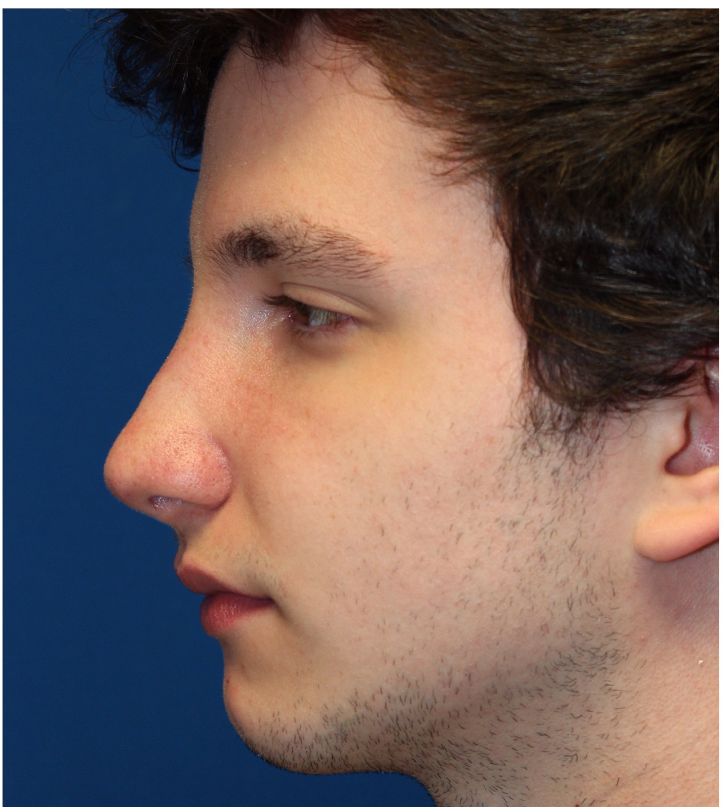 Male Cosmetic Rhinoplasty