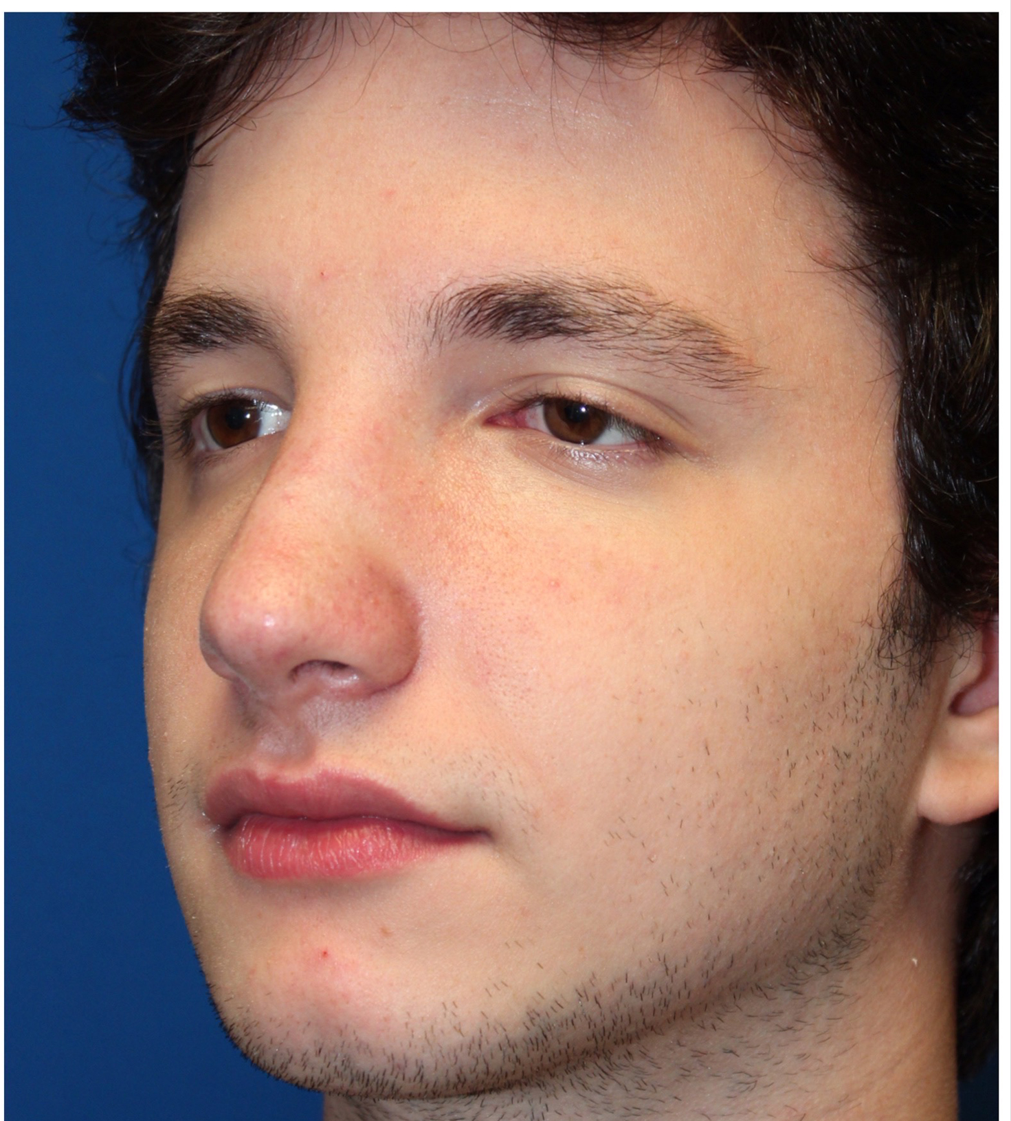 Male Cosmetic Rhinoplasty