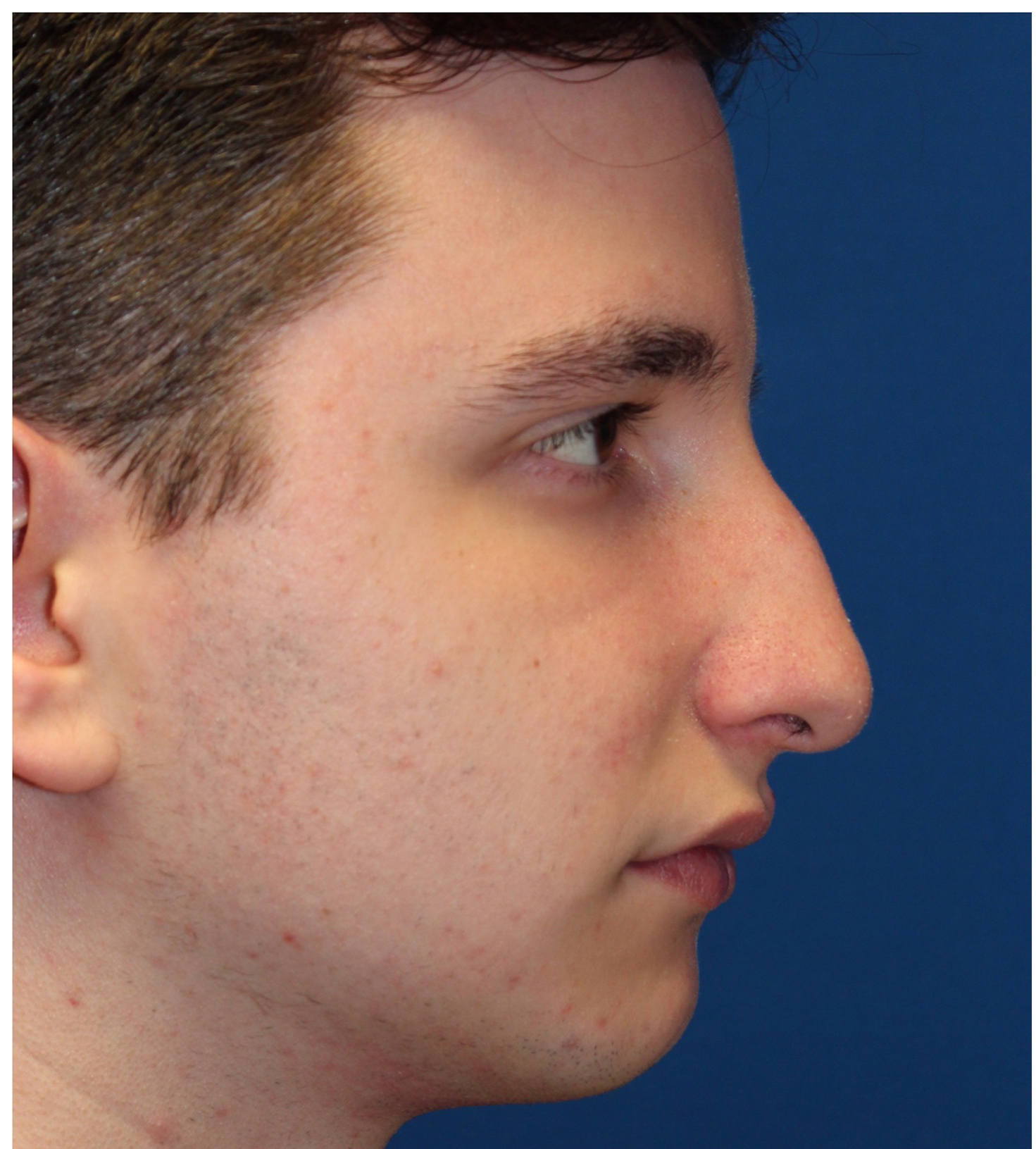 Male Cosmetic Rhinoplasty