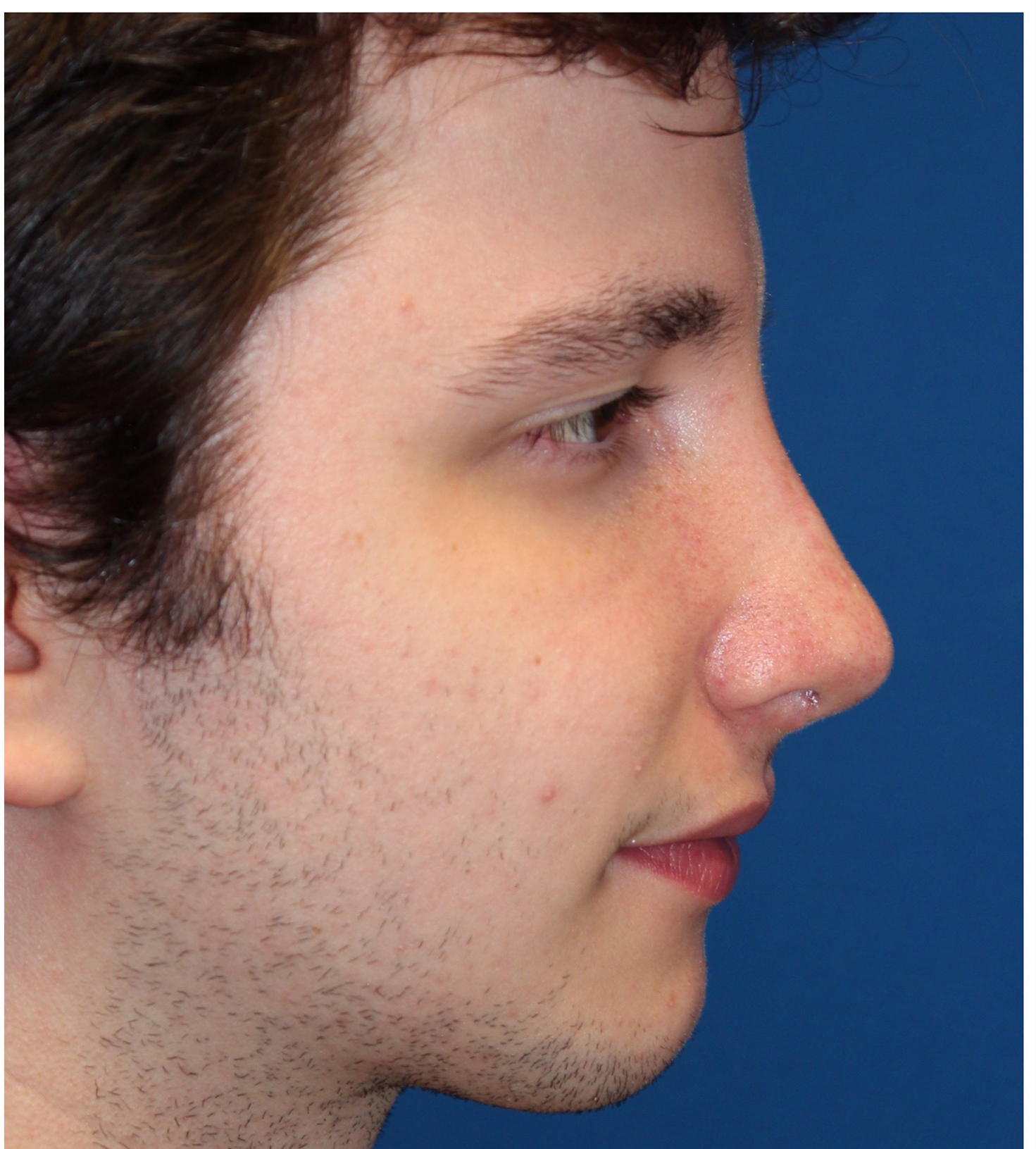 Male Cosmetic Rhinoplasty